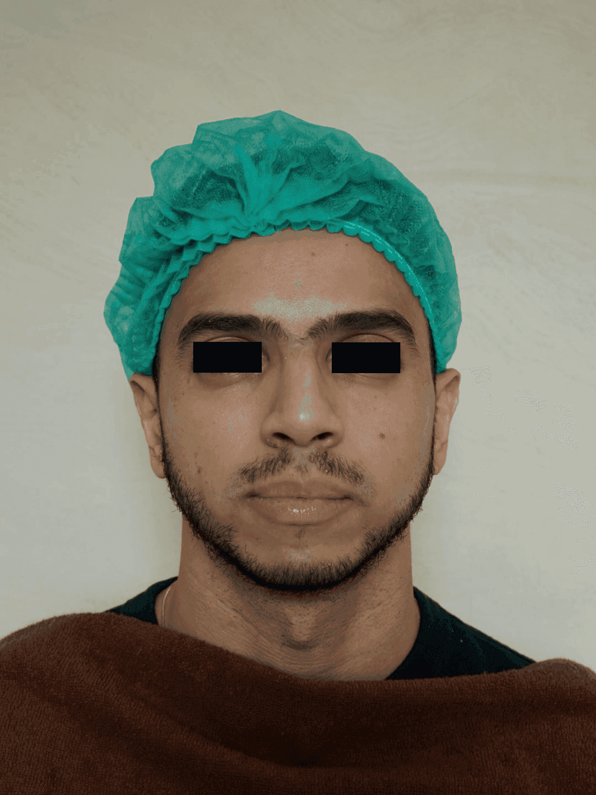Scar Revision