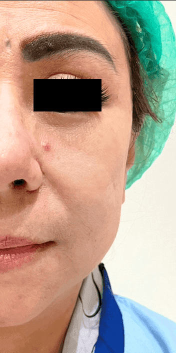 Nevi Removal
