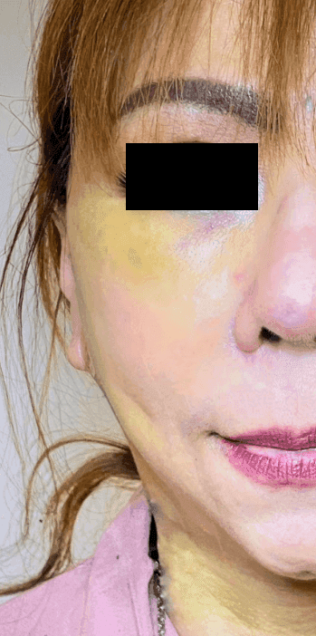Craniosynostosis Surgery