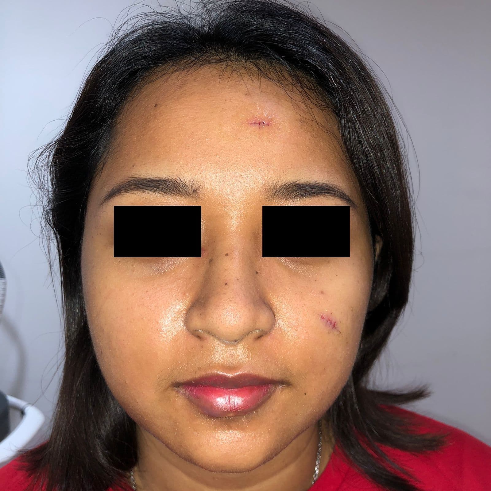 Nevi Removal