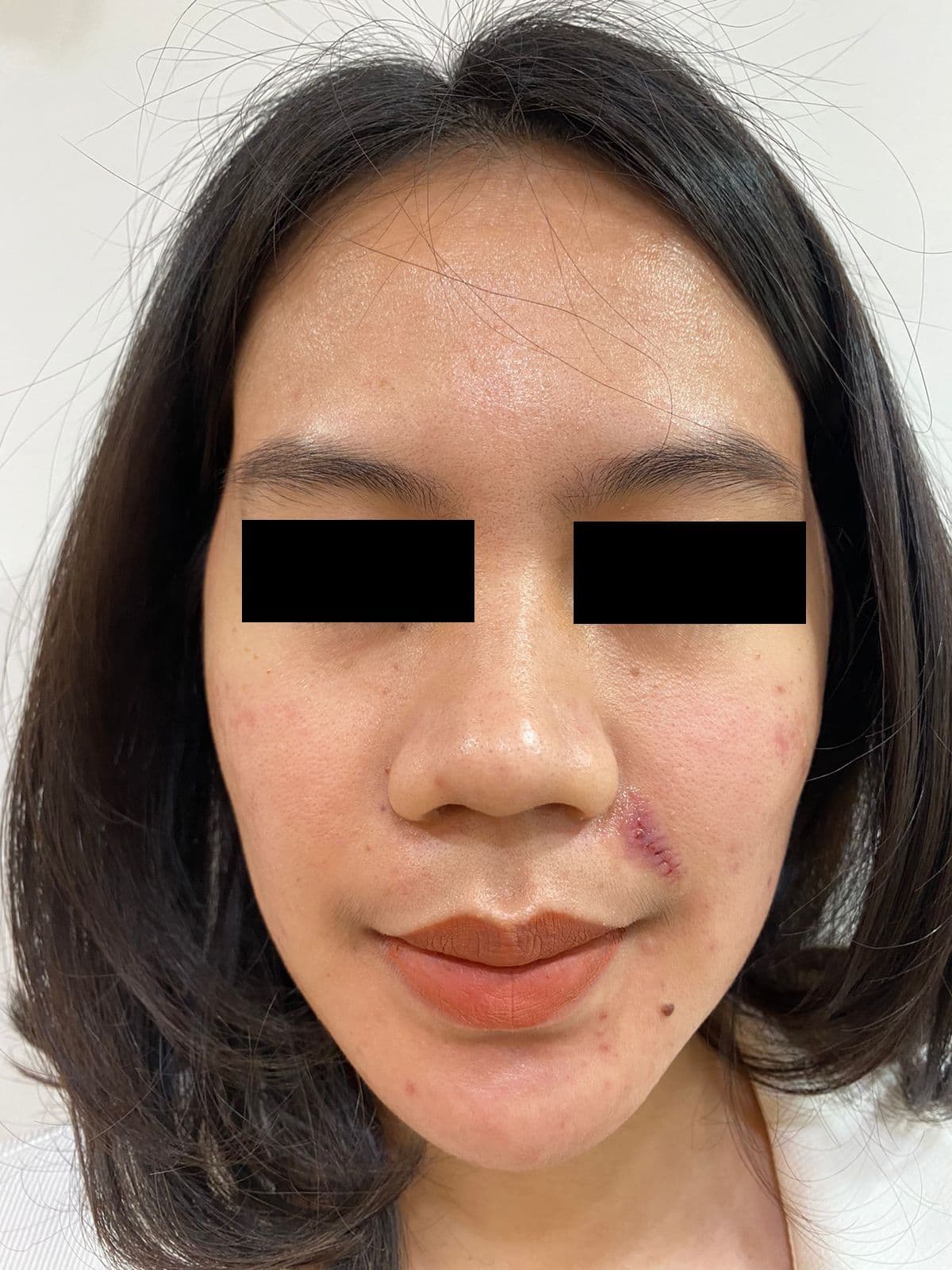 Blepharoplasty