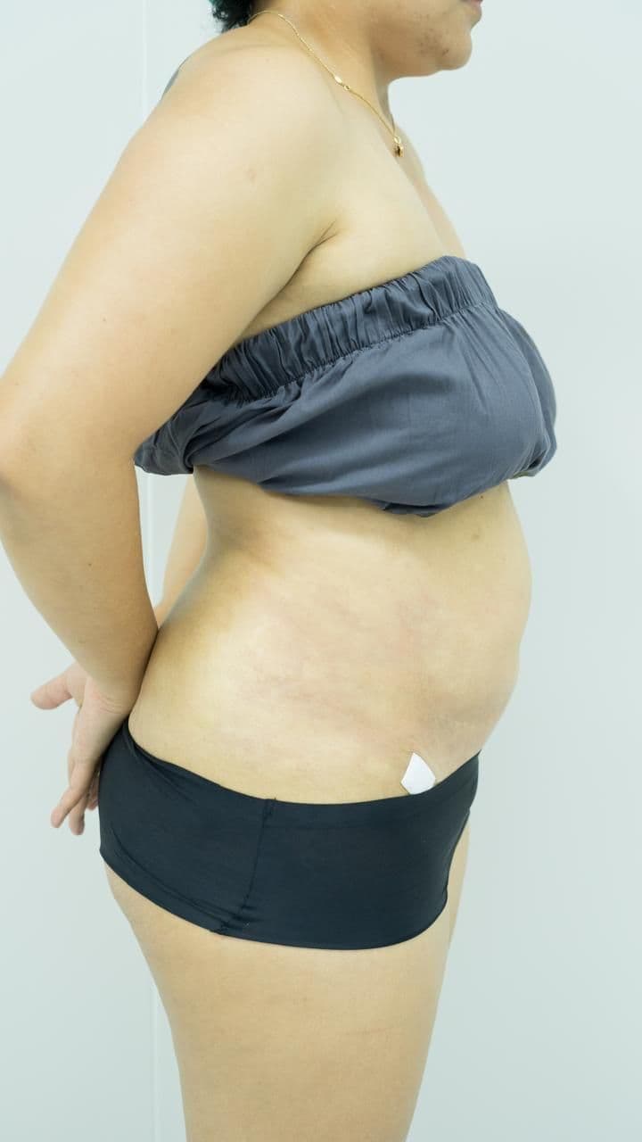 Breast Reconstruction