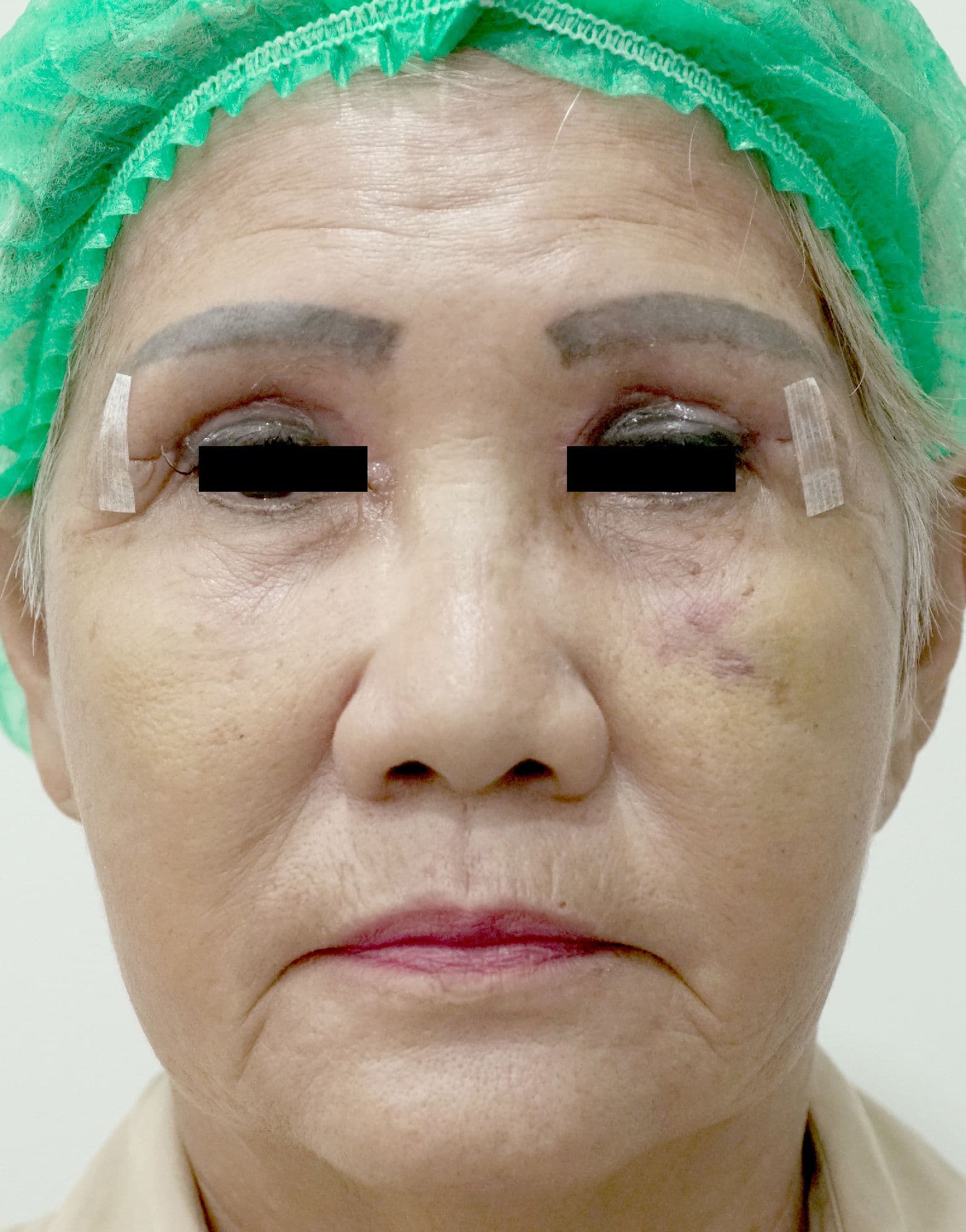 Septoplasty