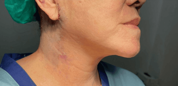 Skin Cancer Removal