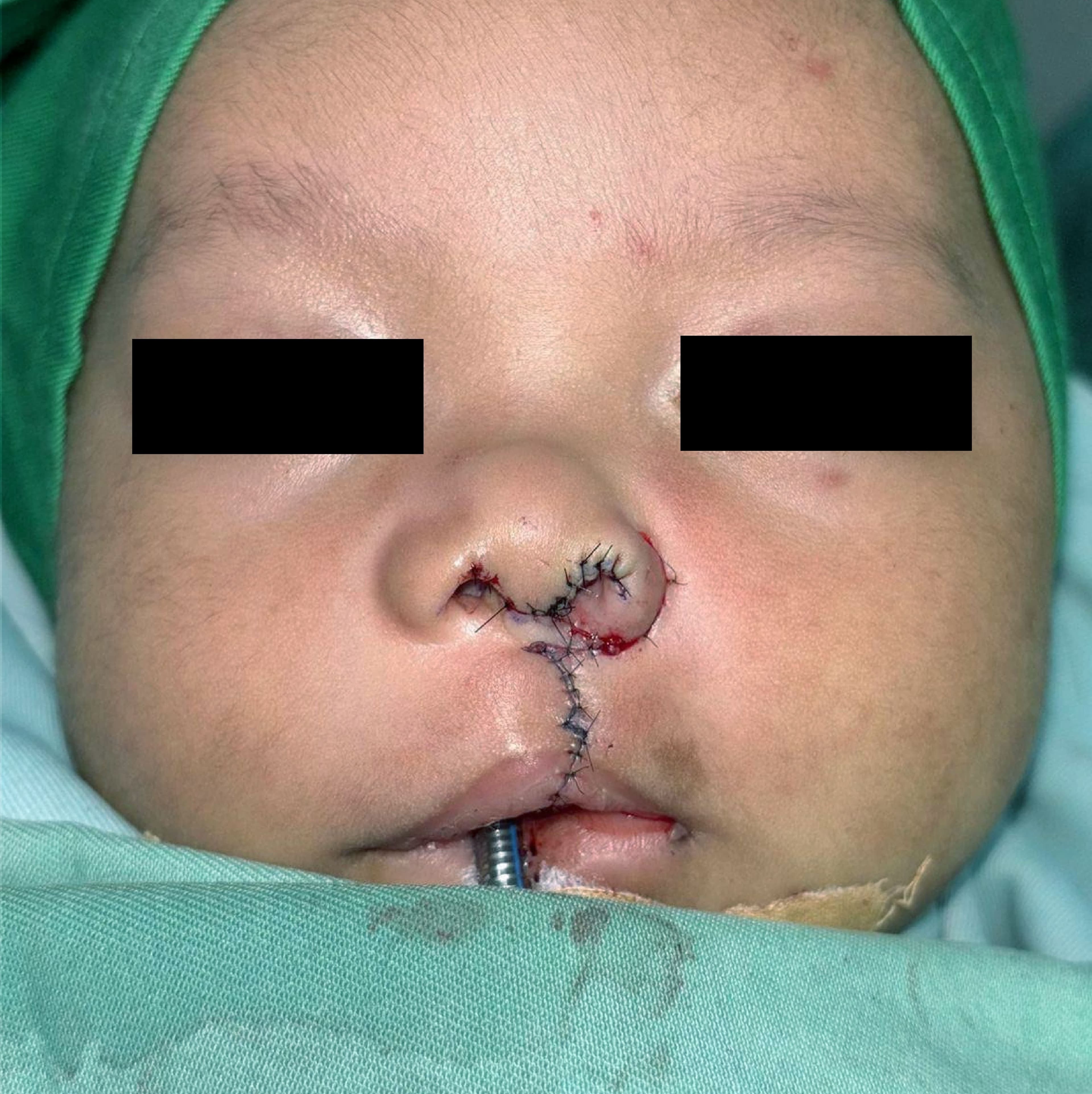 Cleft Lip and Cleft Palate Repair