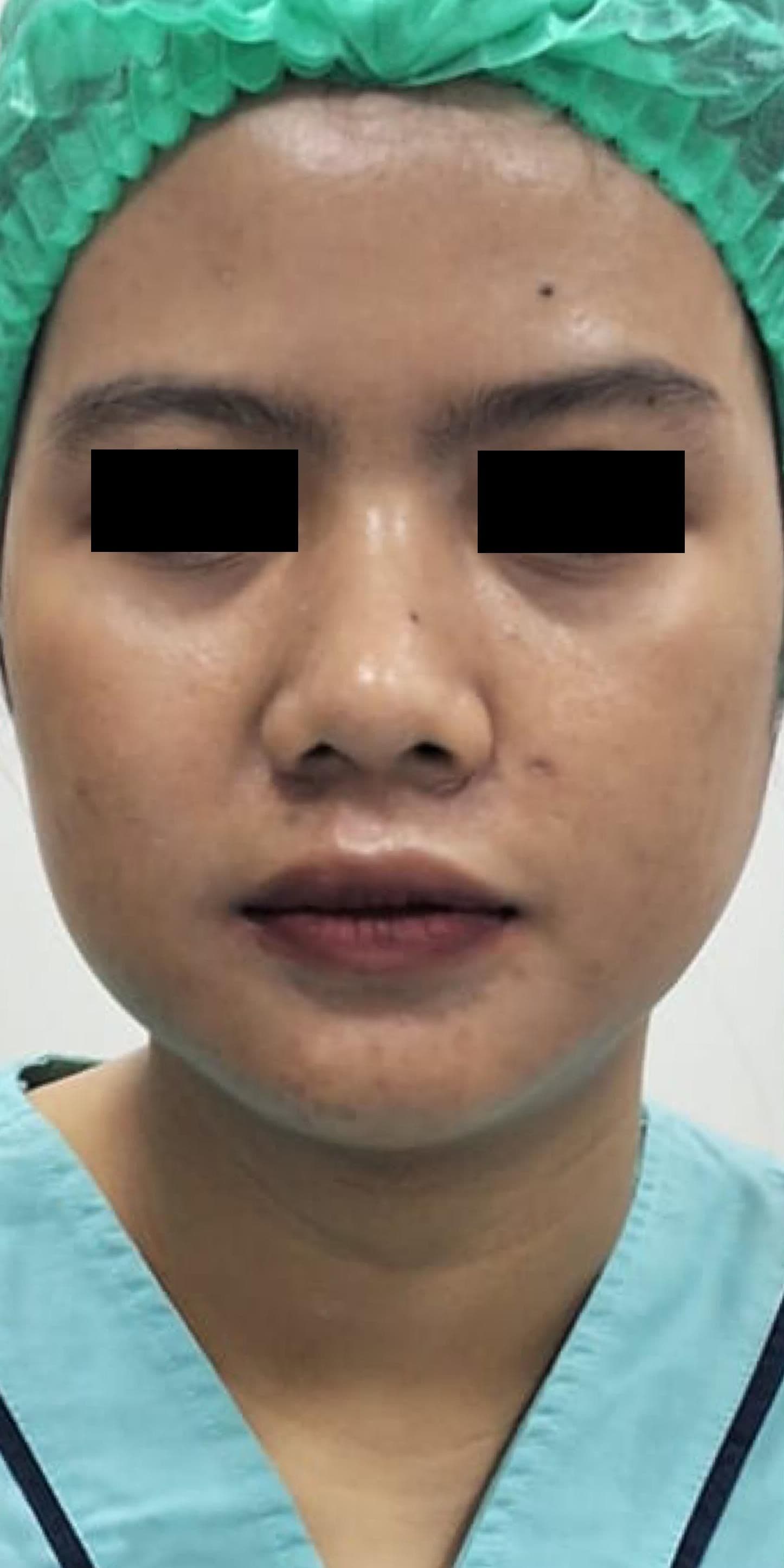 Skin Cancer Removal